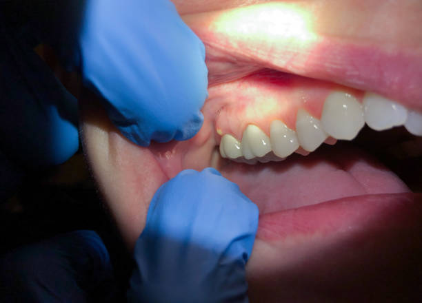 Best Broken or Chipped Tooth Repair in Maize, KS
