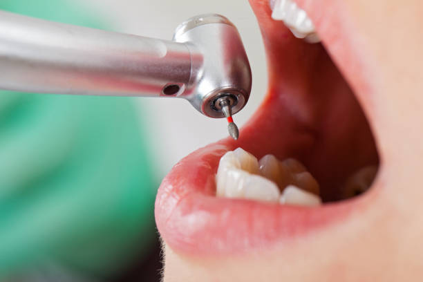 Best Broken or Chipped Tooth Repair in Maize, KS